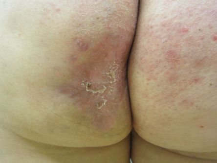 Excisie fistelcomplex op de bil bij hidradenitis suppurativa