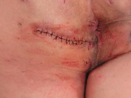 Excisie fistels bil bij hidradenitis