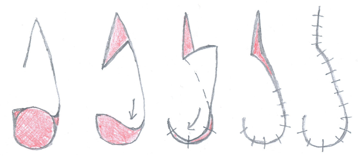 Dorsal nasal rotation flap