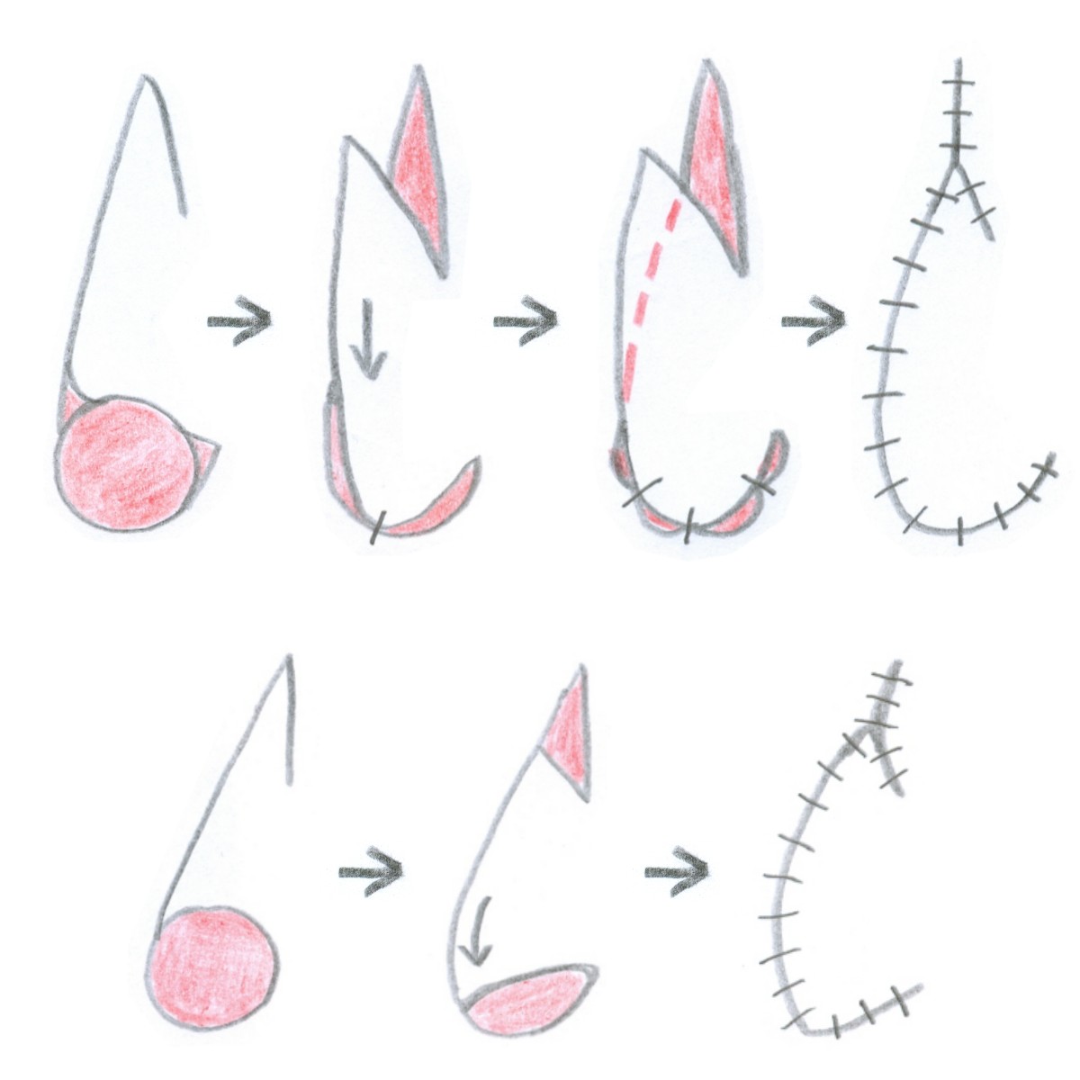 Dorsal nasal rotation flap