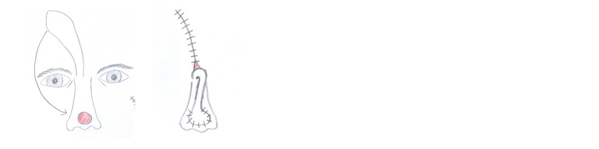 Paramedian forehead flap