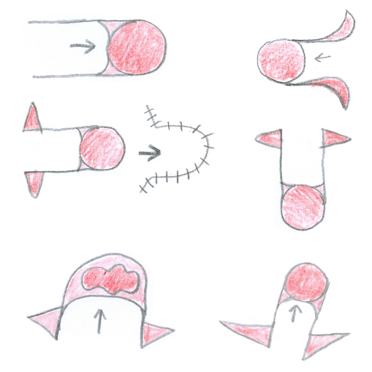 Unilaterale advancement flap