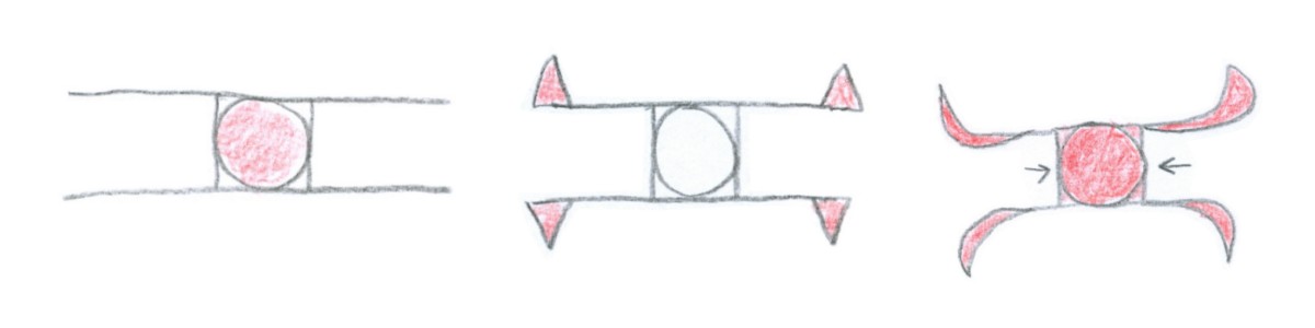 H-plastiek (bilaterale advancement flap)