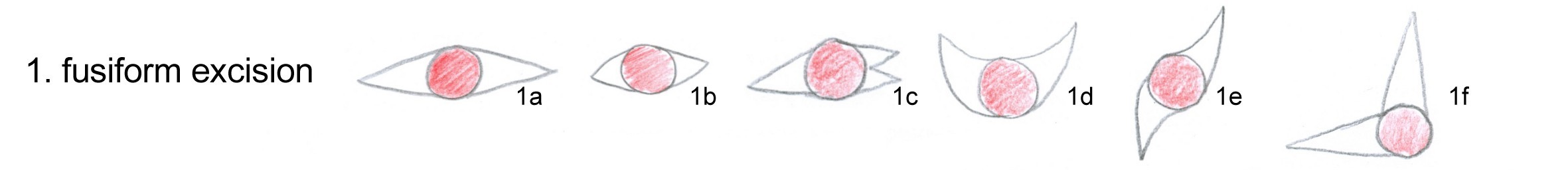 Ovale (fusiforme) excisie, ellips