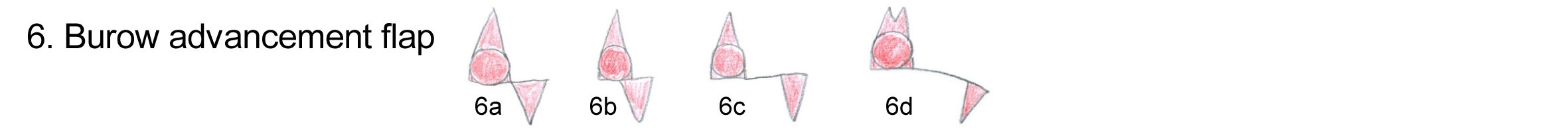 Burow advancement flap