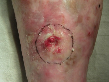 Vrij transplantaat been