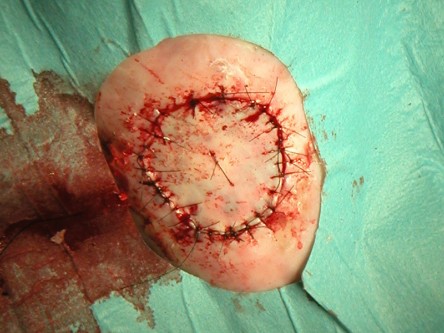 Vrij transplantaat been