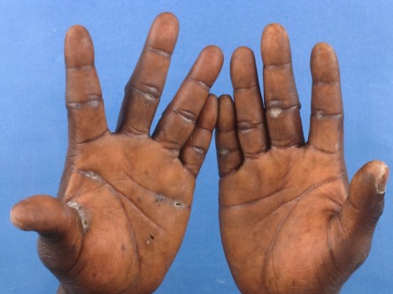 Excisie focal acrale keratosen