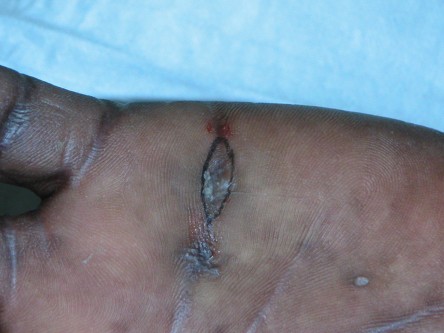 Excisie focal acrale keratosen