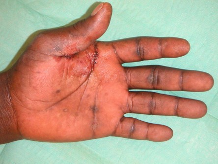 Excisie focal acrale keratosen