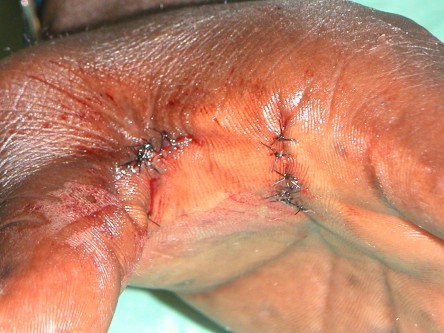 Excisie focal acrale keratosen