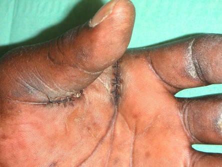 Excisie focal acrale keratosen