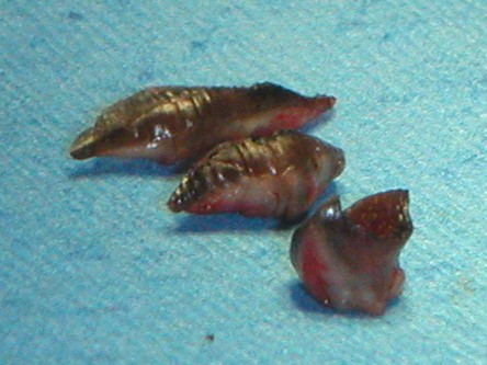 Excisie focal acrale keratosen