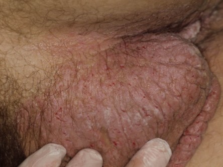 Hailey-Hailey grafting