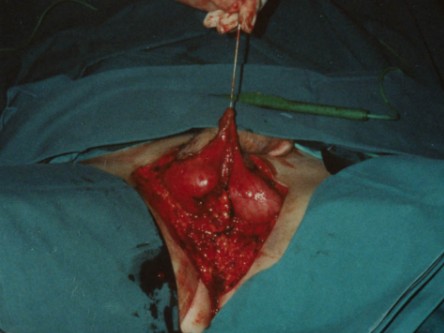 Hailey-Hailey grafting