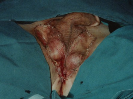 Hailey-Hailey grafting