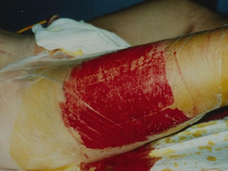 Hailey-Hailey grafting