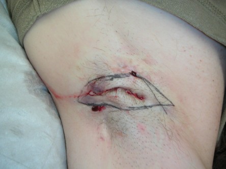 Excisie fistels oksel bij hidradenitis