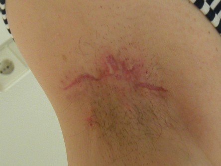 Excisie fistels oksel bij hidradenitis