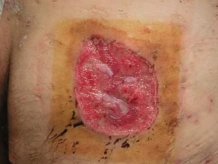 Deroofing bij HS, diep