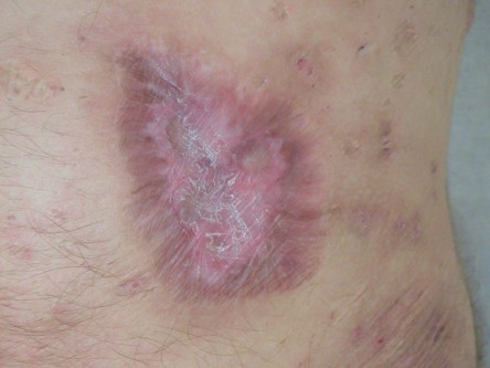 Deroofing bij HS, diep