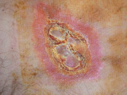 Deroofing bij HS, diep