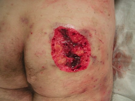 Deroofing bij HS, diep