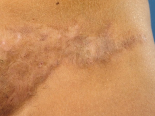 Deroofing bij hidradenitis suppurativa