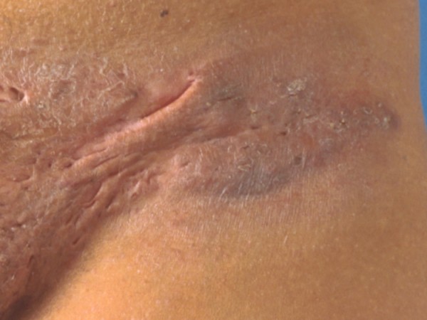 Deroofing bij hidradenitis suppurativa