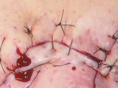 Dubbele katrolhechting