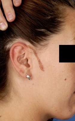 Elektrocoagulatie lineaire epidermale naevus