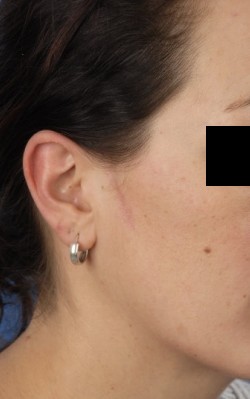 Elektrocoagulatie lineaire epidermale naevus