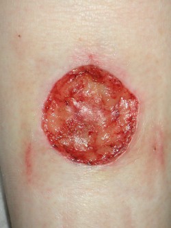 Re-excisie melanoom kuit