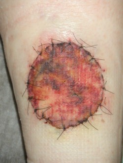 Re-excisie melanoom kuit