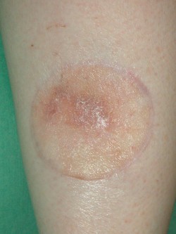 Re-excisie melanoom kuit