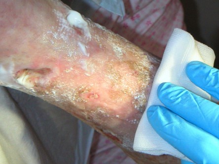 Debridement van ulcera