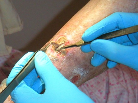 Debridement van ulcera