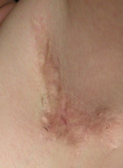 Excisie hidradenitis oksel