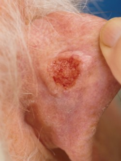 Basaalcelcarcinoom achter oor