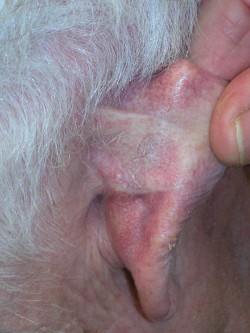 Basaalcelcarcinoom achter oor