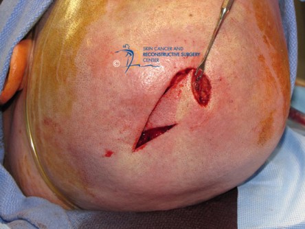 Rotation flap met back cut op de scalp