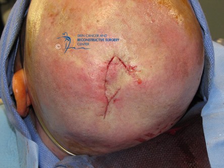 Rotation flap met back cut op de scalp