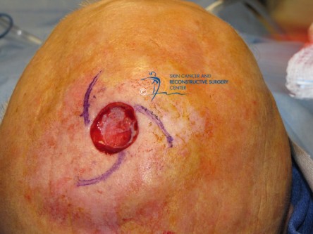 Scalp peninsula flap