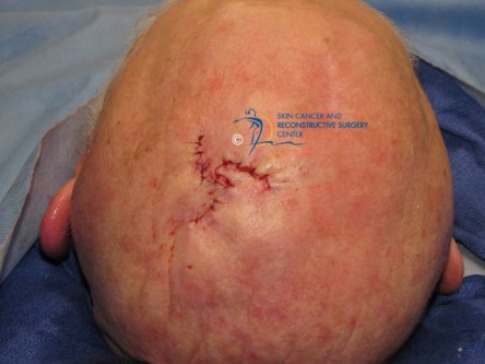 Scalp peninsula flap