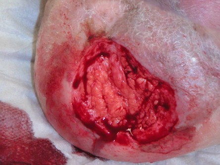 Excisie plaveiselcelcarcinoom