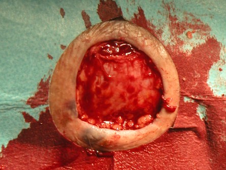 Excisie pretibiaal plaveiselcel carcinoom