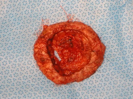 Excisie pretibiaal plaveiselcel carcinoom