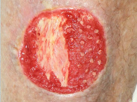 Excisie pretibiaal plaveiselcel carcinoom