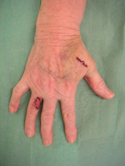 Vrij transplantaat vinger