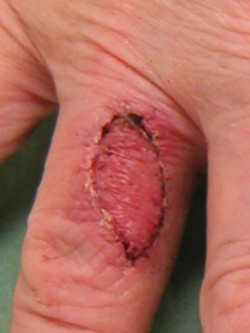 Vrij transplantaat vinger